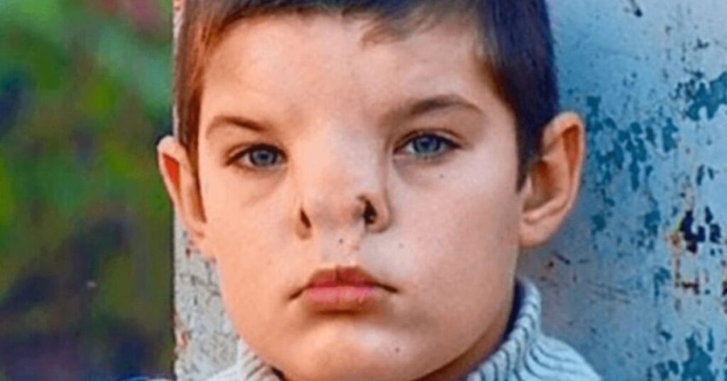 Transformational Surgery Corrects Boy's Facial Deformity, Opens New ...